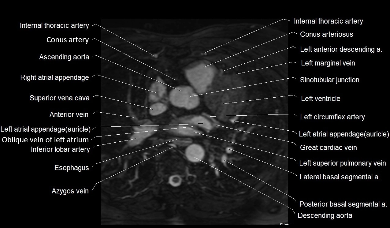 MRI heart coronary arteries and coronary veins anatomy axial image 15.webp
